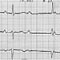 EKG Quiz 62